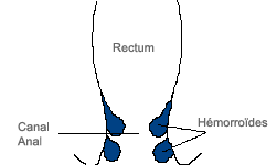 Coupe du canal anal, vue des hémorroïdes